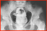 Dildos, plugs, vibrators, bottles, what else? X-ray photos of foreign objects in rectum