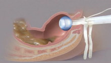 Filename: rectal-catheter-01.png Size: 199.54 KB Uploaded: 10 Nov 2013, 23:42 Views: 84x rectal-catheter-01.png