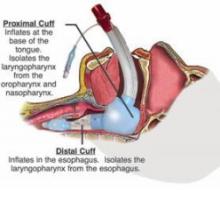  supraglottic-device-gag-03.jpg thumbnail